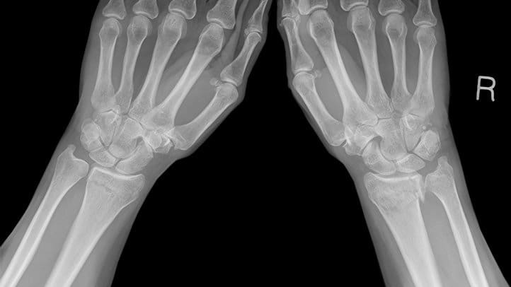 Jauh Sebelum X-Ray Ditemukan, Al-Qur’an telah Jelaskan Osteoporosis 1 X-Ray. Foto: Everyday Health