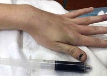 Darah gadis AS berubah jadi berwarna biru. Foto: Daily Star