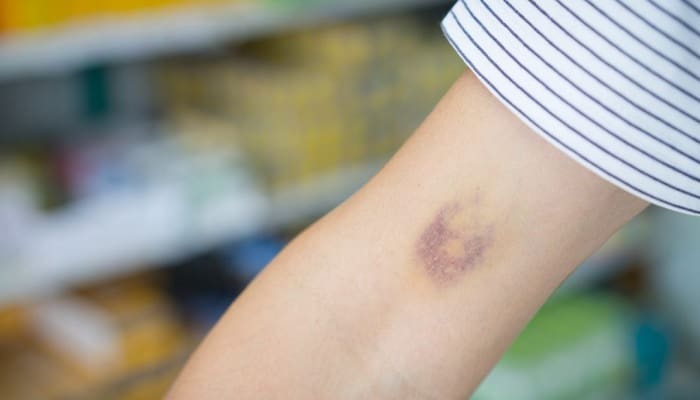 Faktor Penyebab Muncul Lebam pada Orang Meninggal 1 Foto: otc-fahrenheit