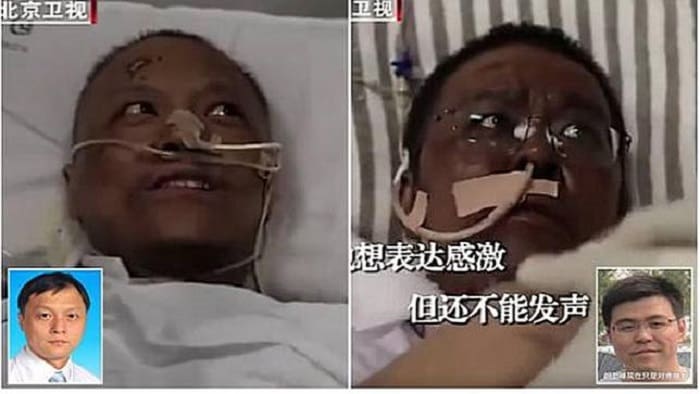 Sembuh dari Covid-19, Kulit 2 Dokter di Wuhan Ini Menghitam 1 2 dokter di Wuhan sembuh dari Covid-19, namun kulit mereka jadi menghitam. Foto: CCTV