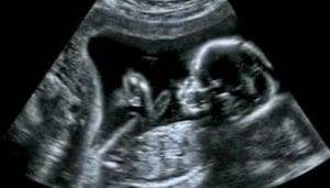Anak Meninggal saat Lahir Apakah Harus Diaqiqahi? 3 Anak Meninggal saat Lahir