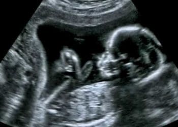 Anak Meninggal saat Lahir