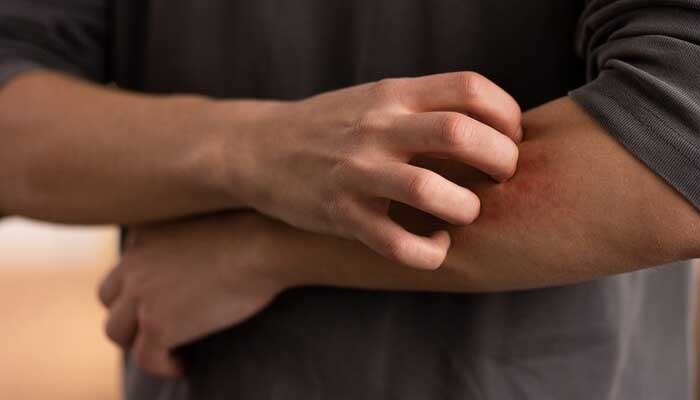 7 Obat Herbal untuk Mengatasi Penyakit Gatal Scabies 1 scabies